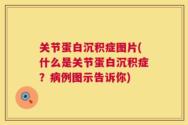 关节蛋白沉积症图片(什么是关节蛋白沉积症?病例图示告诉你)