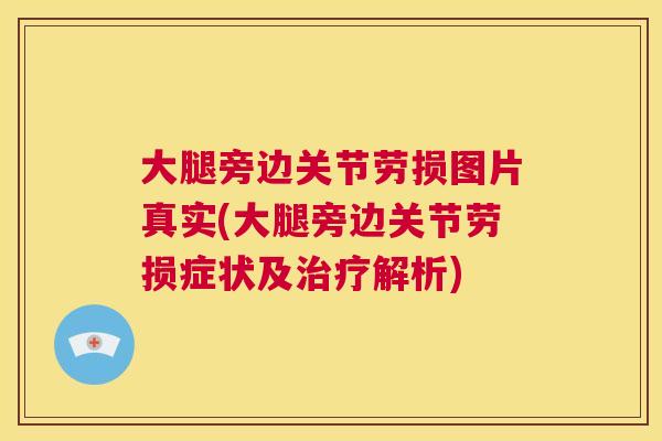 大腿旁边关节劳损图片真实(大腿旁边关节劳损症状及解析) 大腿旁边关节劳损图片真实(大腿旁边关节劳损症状及解析)