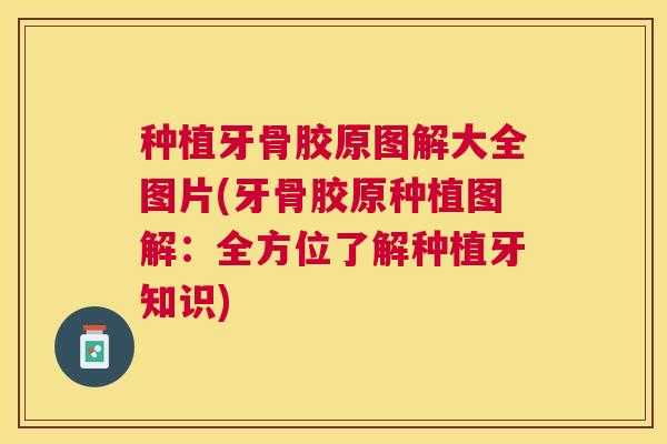 种植牙骨胶原图解大全图片(牙骨胶原种植图解:全方位了解种植牙知识) 种植牙骨胶原图解大全图片(牙骨胶原种植图解:全方位了解种植牙知识)