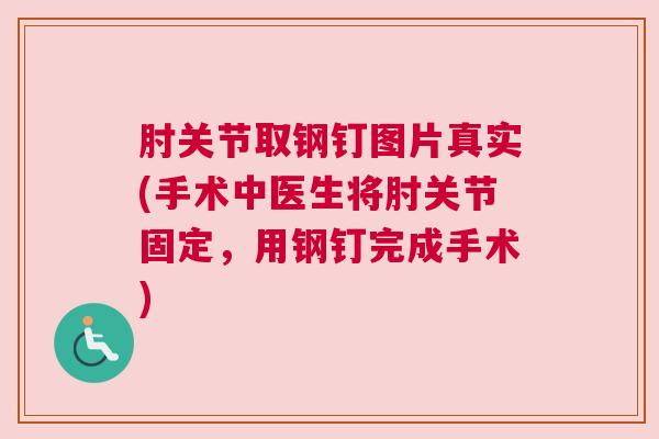 肘关节取钢钉图片真实(手术中医生将肘关节固定,用钢钉完成手术) 肘关节取钢钉图片真实(手术中医生将肘关节固定,用钢钉完成手术)